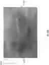 Fig. 74 - Wound closure devices