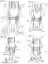 Fig. 09 - Patient mobility garment for nurses