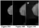 Fig. 14 - Methods of Reducing Mammographic Breast Density and/or Breast Cancer Risk