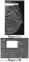 Fig. 16 - Methods of Reducing Mammographic Breast Density and/or Breast Cancer Risk