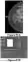 Fig. 17 - Methods of Reducing Mammographic Breast Density and/or Breast Cancer Risk