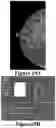 Fig. 18 - Methods of Reducing Mammographic Breast Density and/or Breast Cancer Risk