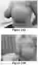 Fig. 22 - Methods of Reducing Mammographic Breast Density and/or Breast Cancer Risk