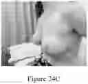Fig. 23 - Methods of Reducing Mammographic Breast Density and/or Breast Cancer Risk