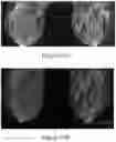 Fig. 24 - Methods of Reducing Mammographic Breast Density and/or Breast Cancer Risk