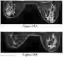 Fig. 27 - Methods of Reducing Mammographic Breast Density and/or Breast Cancer Risk
