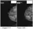 Fig. 31 - Methods of Reducing Mammographic Breast Density and/or Breast Cancer Risk