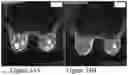 Fig. 33 - Methods of Reducing Mammographic Breast Density and/or Breast Cancer Risk