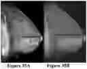 Fig. 34 - Methods of Reducing Mammographic Breast Density and/or Breast Cancer Risk