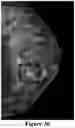 Fig. 35 - Methods of Reducing Mammographic Breast Density and/or Breast Cancer Risk
