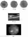 Fig. 02 - Novel Method of Treating Macular Degeneration Using Botulinum Toxin-Based Pharmaceuticals