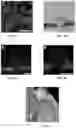 Fig. 04 - Novel Method of Treating Macular Degeneration Using Botulinum Toxin-Based Pharmaceuticals