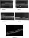 Fig. 07 - Novel Method of Treating Macular Degeneration Using Botulinum Toxin-Based Pharmaceuticals