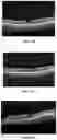 Fig. 08 - Novel Method of Treating Macular Degeneration Using Botulinum Toxin-Based Pharmaceuticals
