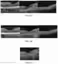 Fig. 09 - Novel Method of Treating Macular Degeneration Using Botulinum Toxin-Based Pharmaceuticals