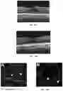 Fig. 10 - Novel Method of Treating Macular Degeneration Using Botulinum Toxin-Based Pharmaceuticals