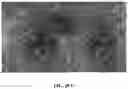 Fig. 19 - Novel Method of Treating Macular Degeneration Using Botulinum Toxin-Based Pharmaceuticals