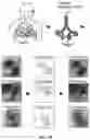 Fig. 28 - Method and apparatus for computer-vision guided targeted delivery of small liquid volumes into selected lung regions