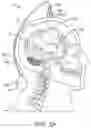 Fig. 03 - Apparatus, systems and methods for delivery of medication to the brain to treat neurological conditions