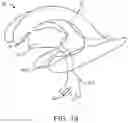 Fig. 34 - Apparatus, systems and methods for delivery of medication to the brain to treat neurological conditions