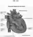 Fig. 02 - Method for positioning terminal end of pacemaker lead, which has passed through coronary sinus, in interventricular septum
