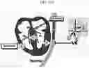 Fig. 04 - Method for positioning terminal end of pacemaker lead, which has passed through coronary sinus, in interventricular septum
