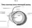Fig. 07 - Method for positioning terminal end of pacemaker lead, which has passed through coronary sinus, in interventricular septum