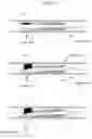 Fig. 12 - Method for positioning terminal end of pacemaker lead, which has passed through coronary sinus, in interventricular septum