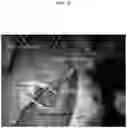 Fig. 13 - Method for positioning terminal end of pacemaker lead, which has passed through coronary sinus, in interventricular septum