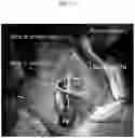 Fig. 14 - Method for positioning terminal end of pacemaker lead, which has passed through coronary sinus, in interventricular septum