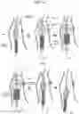 Fig. 17 - Method for positioning terminal end of pacemaker lead, which has passed through coronary sinus, in interventricular septum