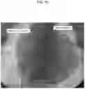 Fig. 20 - Method for positioning terminal end of pacemaker lead, which has passed through coronary sinus, in interventricular septum