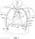 Fig. 02 - Implantable medical devices, systems, and methods for selection of optimal diaphragmatic stimulation parameters to affect pressures within the intrathoracic cavity
