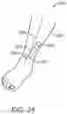 Fig. 15 - Miniature implantable neurostimulator system for sciatic nerves and their branches