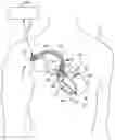 Fig. 01 - Extra-cardiovascular cardiac pacing system for delivering composite pacing pulses