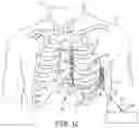 Fig. 03 - Extra-cardiovascular cardiac pacing system for delivering composite pacing pulses