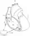 Fig. 01 - Atrial tracking in an intracardiac ventricular pacemaker