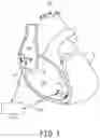 Fig. 02 - Atrial tracking in an intracardiac ventricular pacemaker