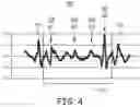 Fig. 05 - Atrial tracking in an intracardiac ventricular pacemaker
