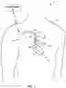 Fig. 02 - Adaptive cardiac resynchronization therapy
