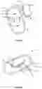 Fig. 10 - External pulse generator device and affixation device for trial nerve stimulation and methods of use