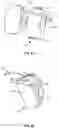 Fig. 11 - External pulse generator device and affixation device for trial nerve stimulation and methods of use
