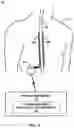 Fig. 02 - Cathode-minimized stimulation programming