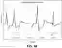 Fig. 13 - Cardiac device system