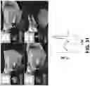 Fig. 31 - Soft shear force resistive sensor embedded in artificial skin