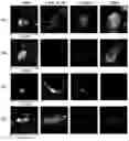 Fig. 01 - METHODS OF USING GIANT CELL NUCLEIC ACID CHARACTERIZATION IN CANCER SCREENING, DIAGNOSTICS, TREATMENT AND RECURRENCE