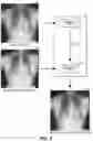 Fig. 08 - Bone suppression for chest radiographs using deep learning