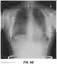 Fig. 11 - Bone suppression for chest radiographs using deep learning