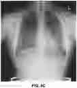 Fig. 12 - Bone suppression for chest radiographs using deep learning