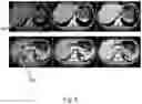 Fig. 05 - Automatic CT detection and visualization of active bleeding and blood extravasation